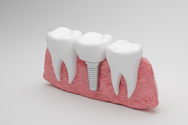 Benefits To Replace Missing Teeth With Dental Implants