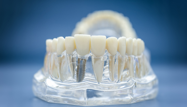 The Advantages Of A Single Tooth Implant