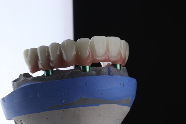 Full Arch Treatment: Before, During, And After