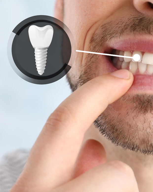 dental implant